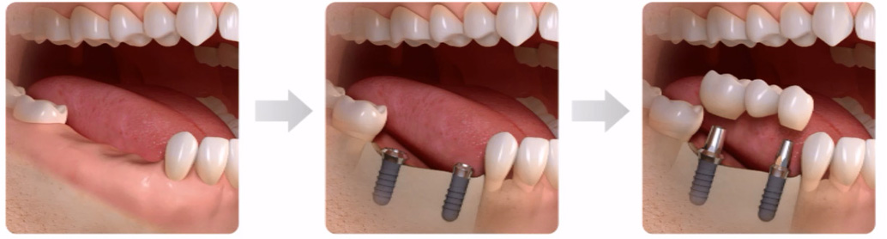 歯を数本失った場合のインプラント